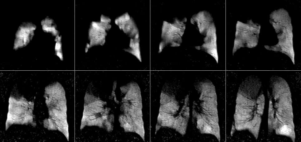 Eight magnetic resonance images of the lungs of a patient with chronic obstructive pulmonary disease. Large dark patches interrupt the bright lung areas.